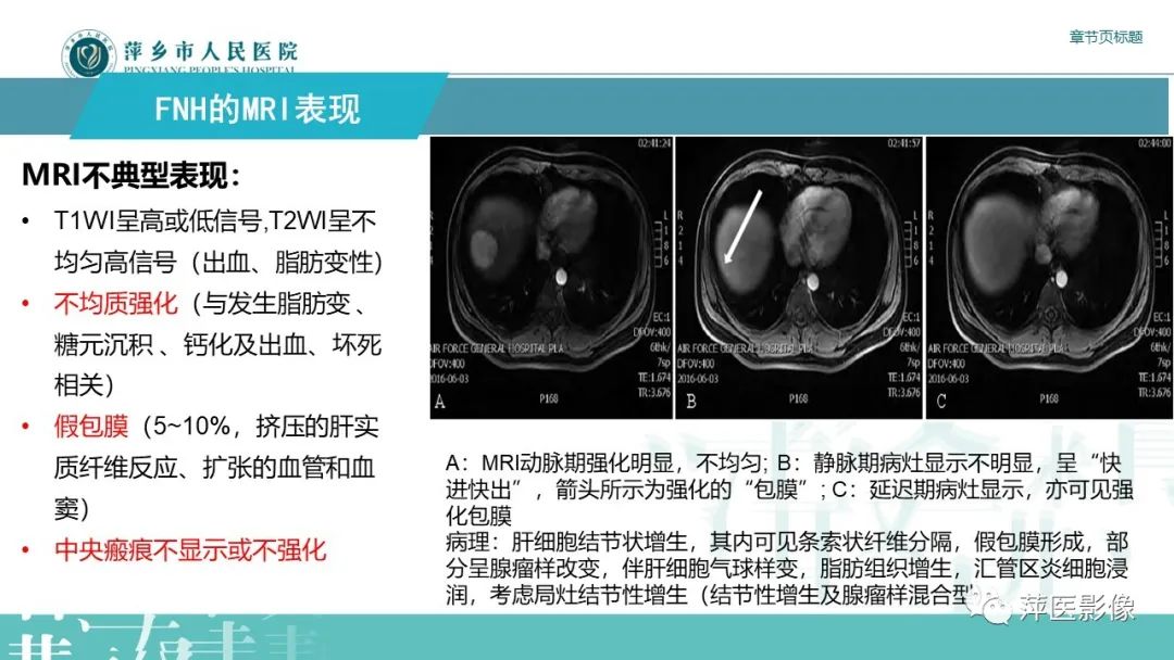 影像PPT - 【PPT】肝脏局灶性结节性增生(FNH)-17