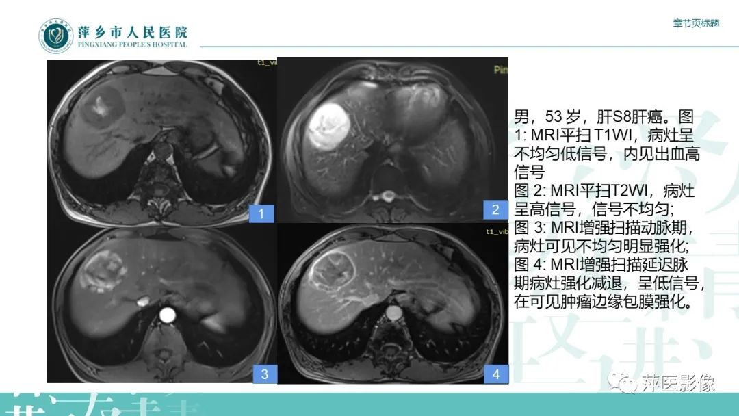 影像PPT - 【PPT】肝脏局灶性结节性增生(FNH)-20