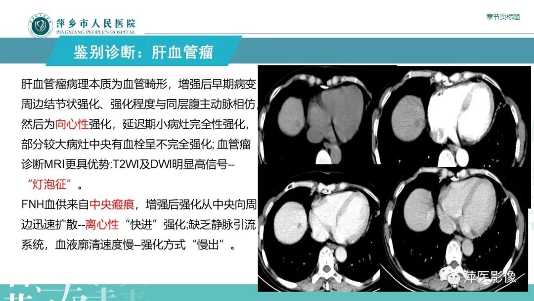 影像PPT - 【PPT】肝脏局灶性结节性增生(FNH)-22