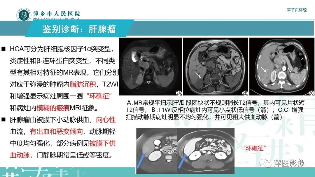 影像PPT - 【PPT】肝脏局灶性结节性增生(FNH)-21