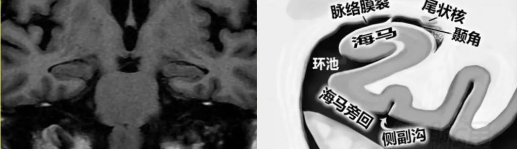 影像PPT - 海马MRI该如何扫描-7 影像PPT - 海马MRI该如何扫描-7