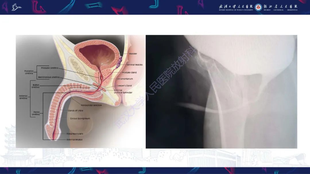 影像PPT - 【PPT】尿道造影疾病诊断-3