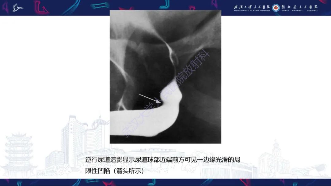 影像PPT - 【PPT】尿道造影疾病诊断-11