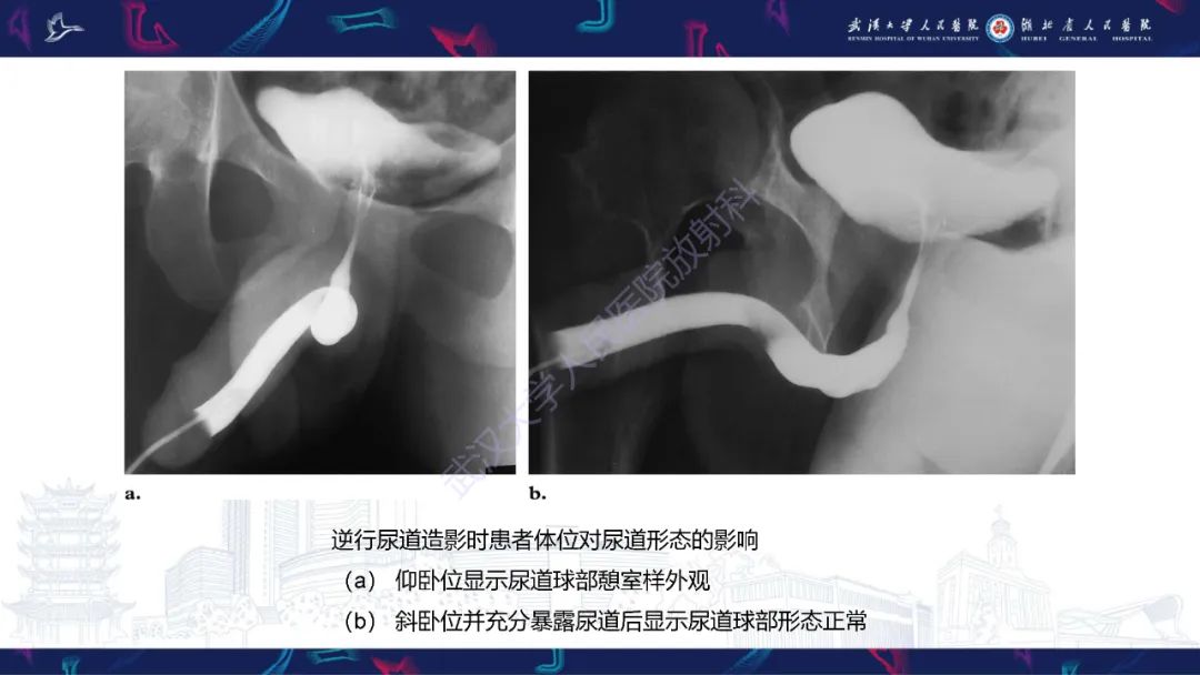 影像PPT - 【PPT】尿道造影疾病诊断-13