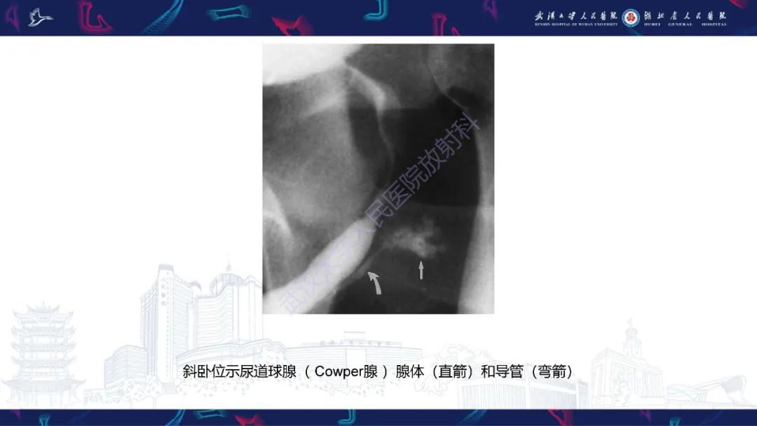 影像PPT - 【PPT】尿道造影疾病诊断-14