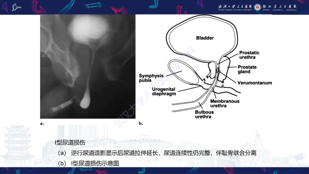影像PPT - 【PPT】尿道造影疾病诊断-19