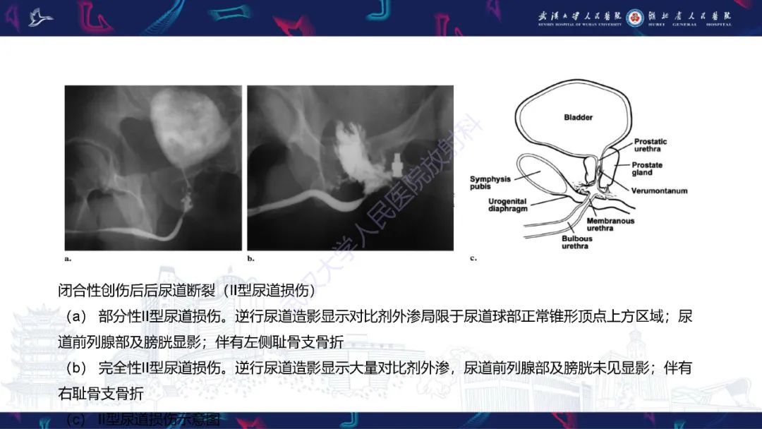 影像PPT - 【PPT】尿道造影疾病诊断-21