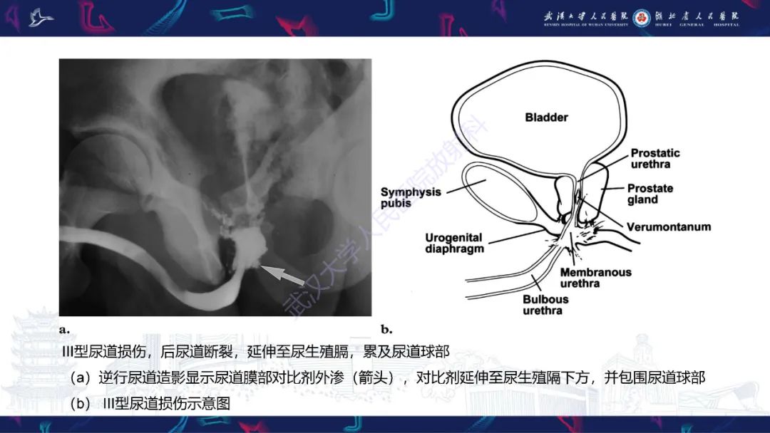 影像PPT - 【PPT】尿道造影疾病诊断-23