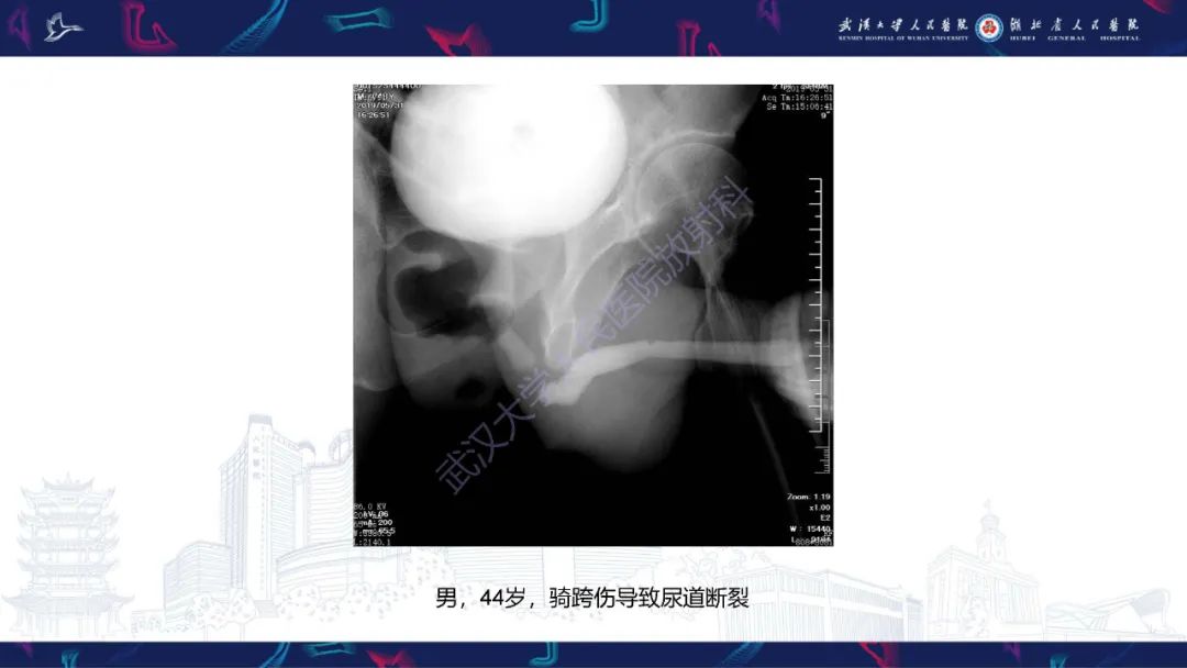 影像PPT - 【PPT】尿道造影疾病诊断-24