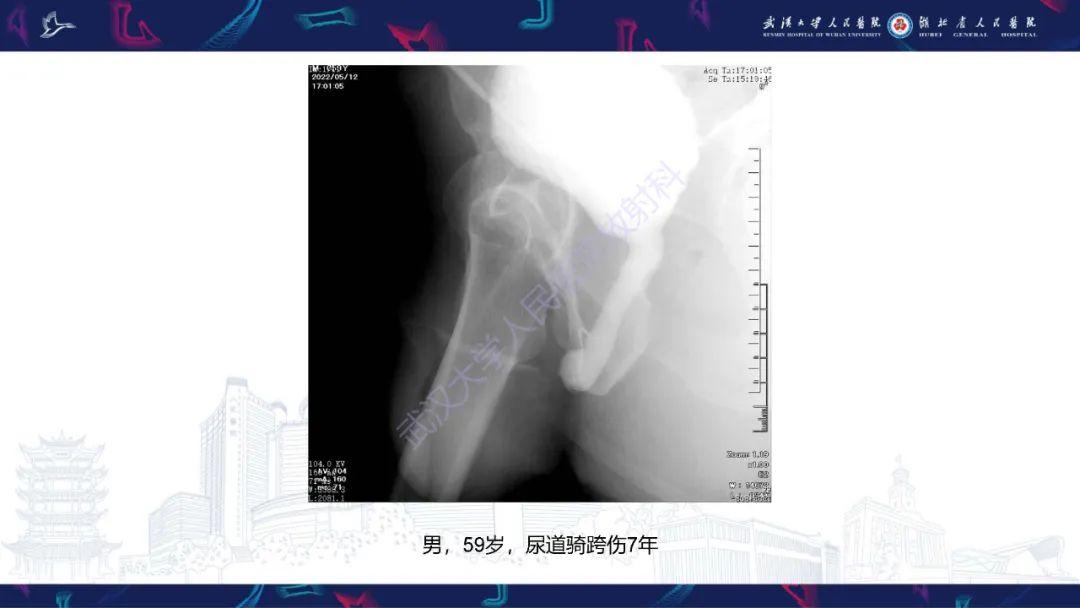 影像PPT - 【PPT】尿道造影疾病诊断-25