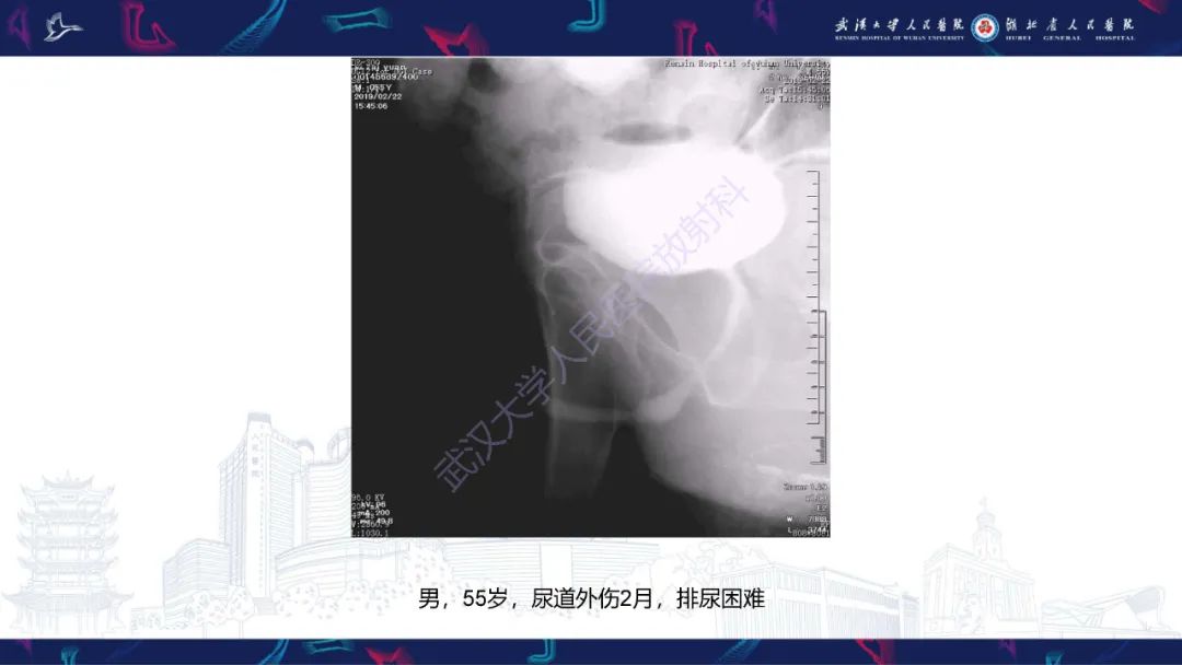 影像PPT - 【PPT】尿道造影疾病诊断-26