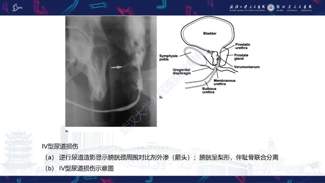 影像PPT - 【PPT】尿道造影疾病诊断-28