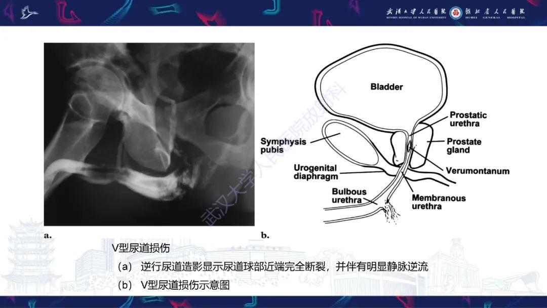 影像PPT - 【PPT】尿道造影疾病诊断-30
