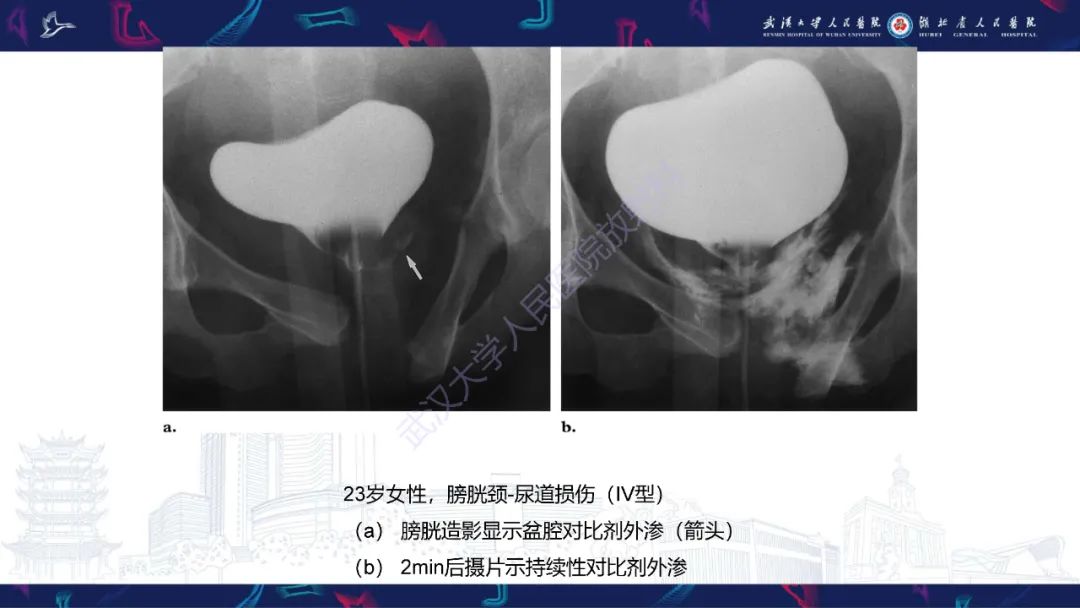 影像PPT - 【PPT】尿道造影疾病诊断-32