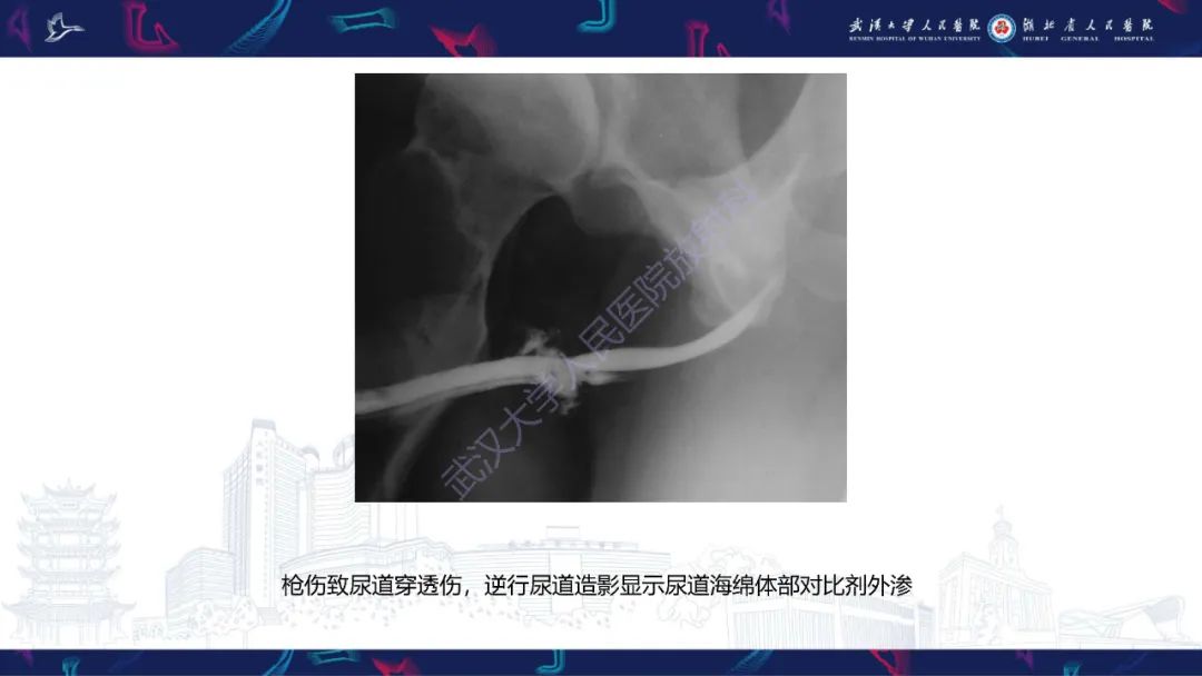 影像PPT - 【PPT】尿道造影疾病诊断-34