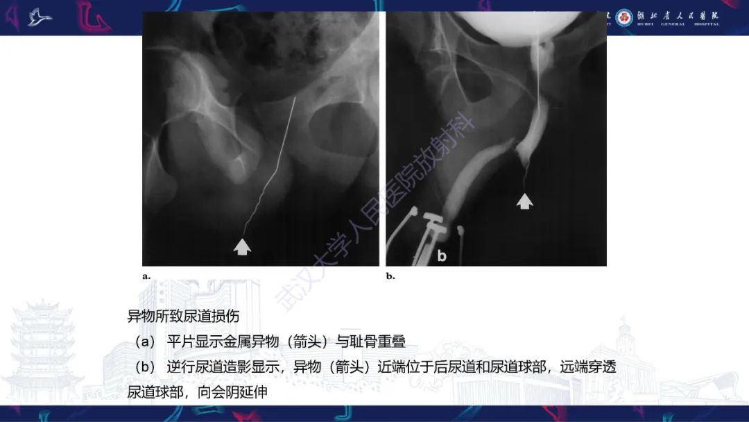 影像PPT - 【PPT】尿道造影疾病诊断-35