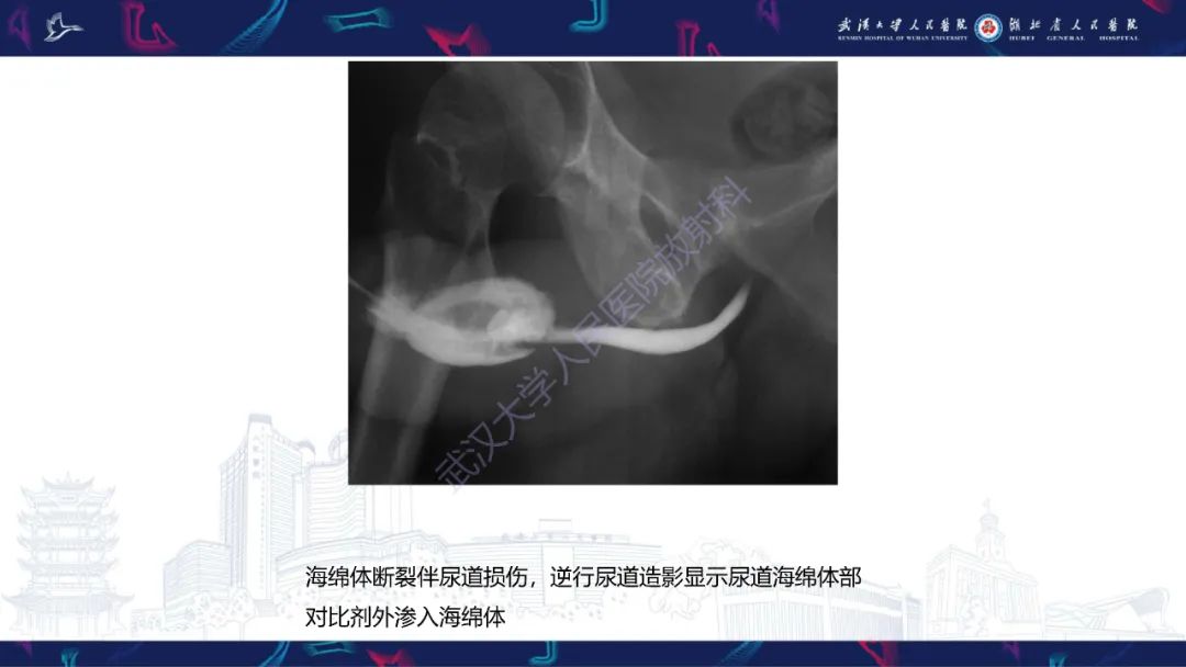 影像PPT - 【PPT】尿道造影疾病诊断-37