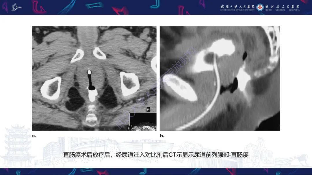 影像PPT - 【PPT】尿道造影疾病诊断-39