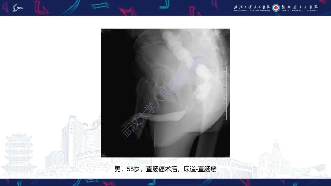 影像PPT - 【PPT】尿道造影疾病诊断-40