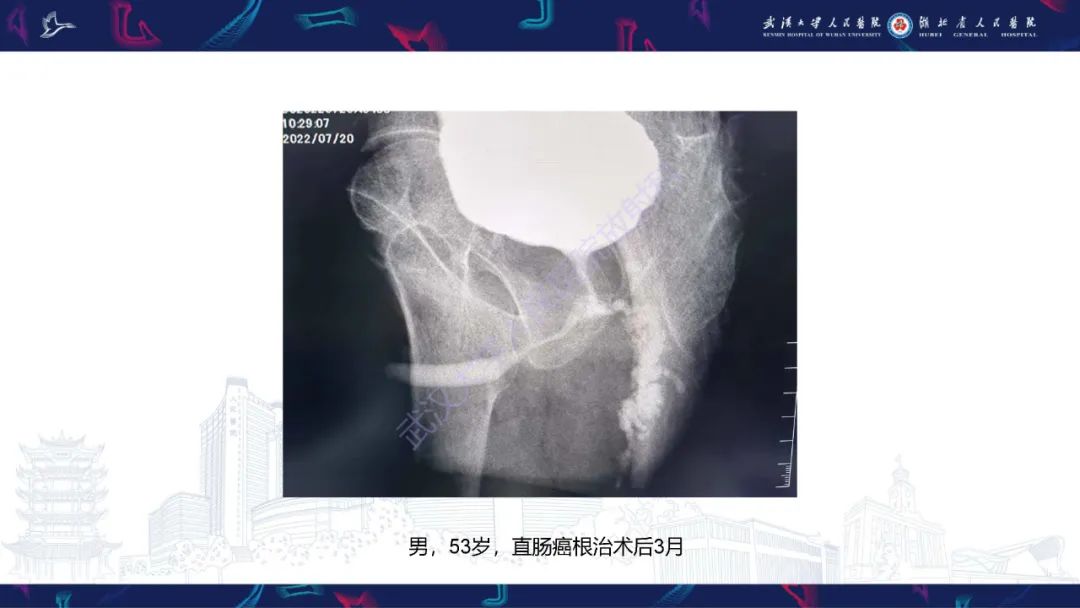 影像PPT - 【PPT】尿道造影疾病诊断-41