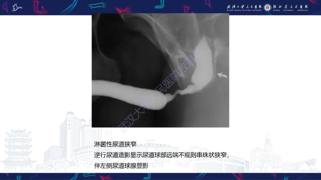 影像PPT - 【PPT】尿道造影疾病诊断-43