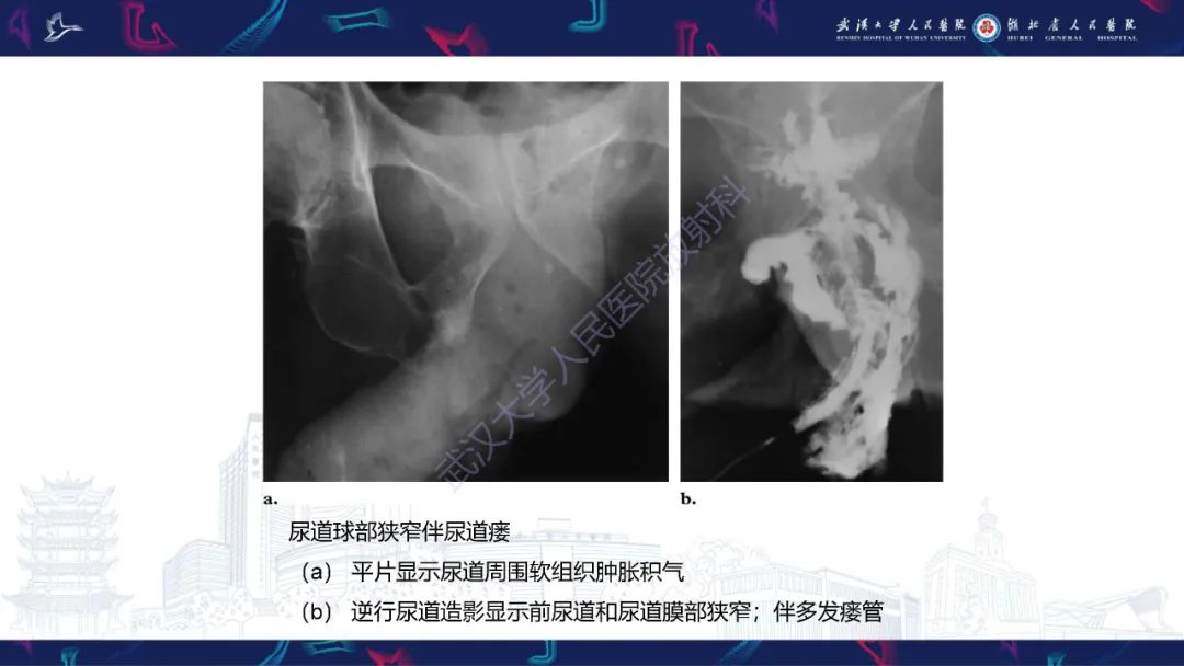 影像PPT - 【PPT】尿道造影疾病诊断-45