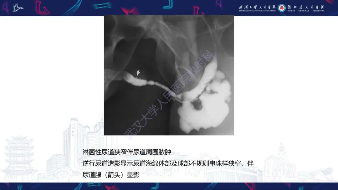 影像PPT - 【PPT】尿道造影疾病诊断-44