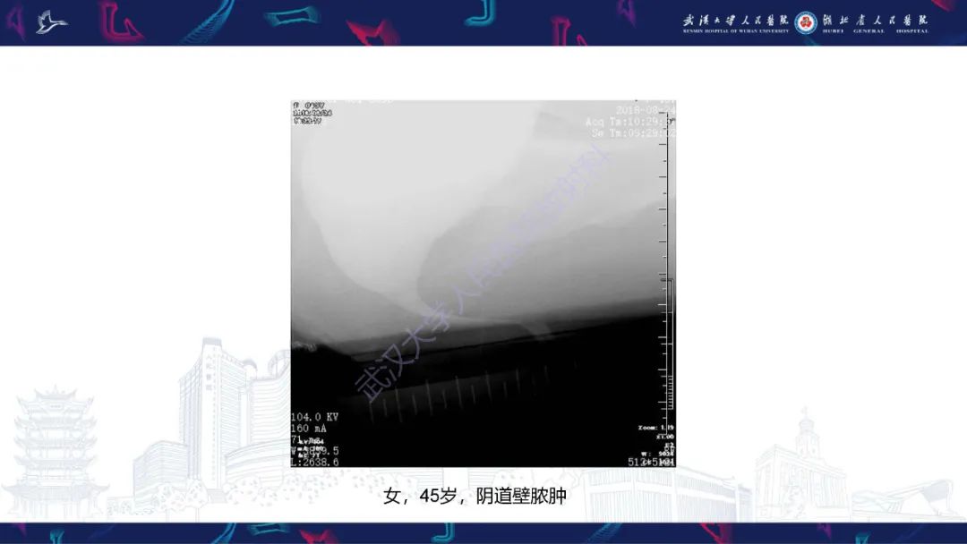影像PPT - 【PPT】尿道造影疾病诊断-46