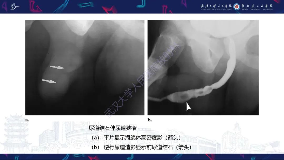 影像PPT - 【PPT】尿道造影疾病诊断-50