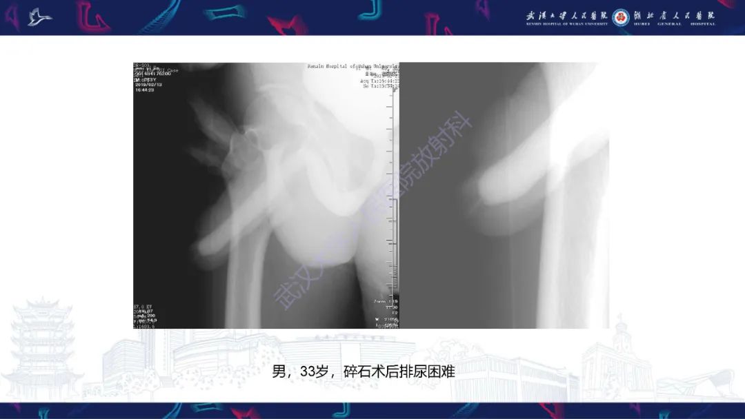 影像PPT - 【PPT】尿道造影疾病诊断-51