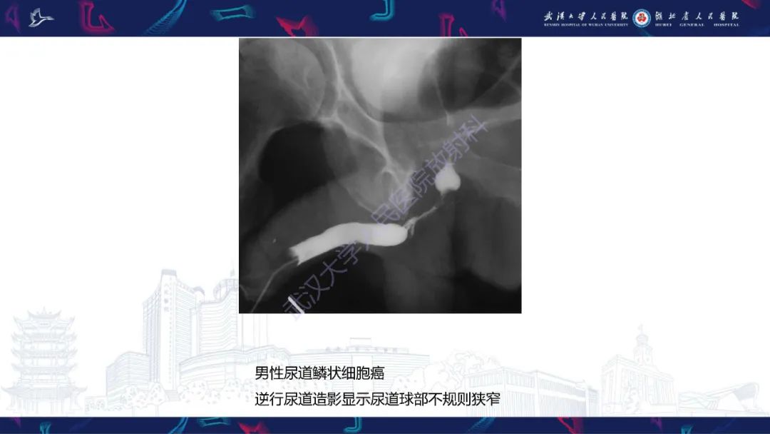 影像PPT - 【PPT】尿道造影疾病诊断-53