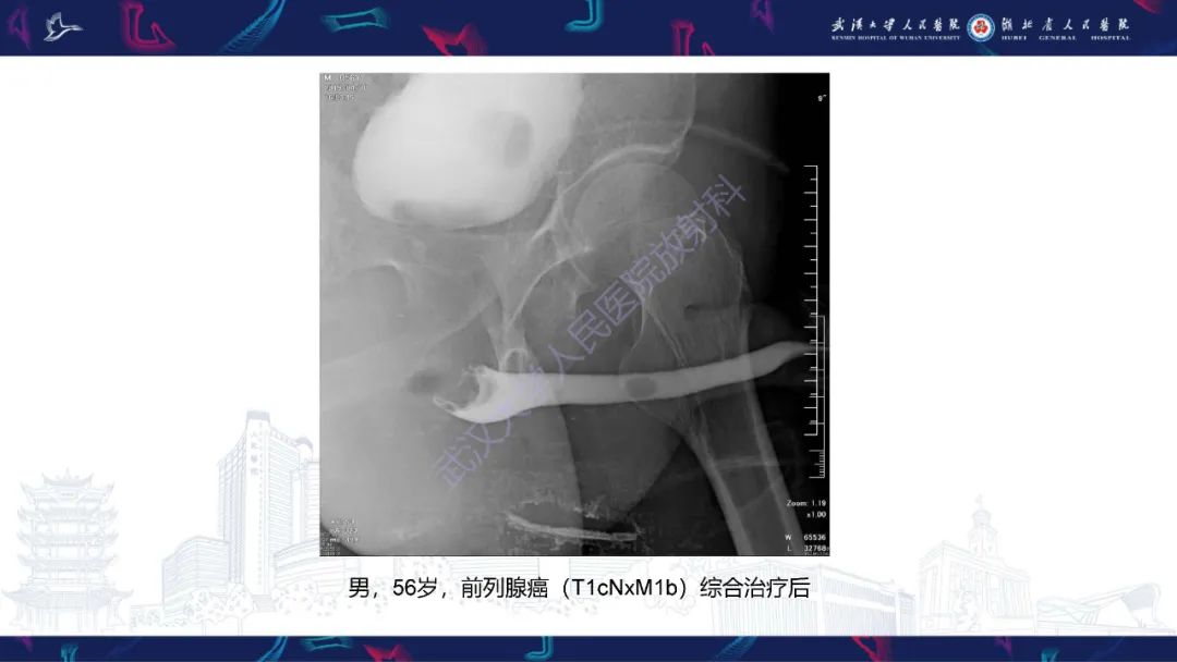 影像PPT - 【PPT】尿道造影疾病诊断-55