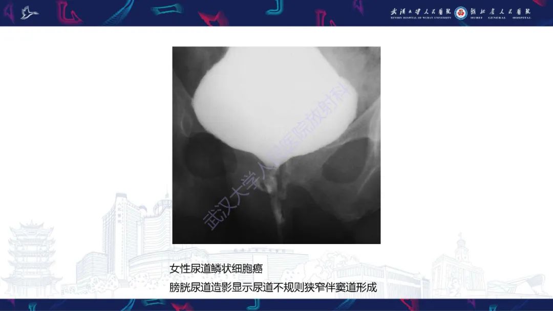 影像PPT - 【PPT】尿道造影疾病诊断-57
