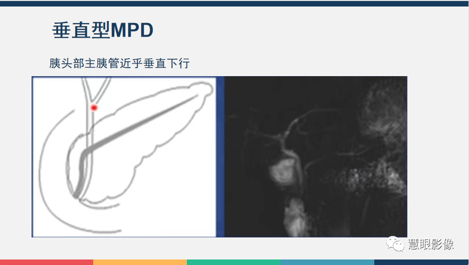 影像PPT - 【PPT】胰腺解剖变异、发育异常及相关病变影像评估-7