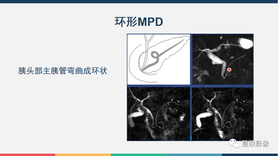 影像PPT - 【PPT】胰腺解剖变异、发育异常及相关病变影像评估-8