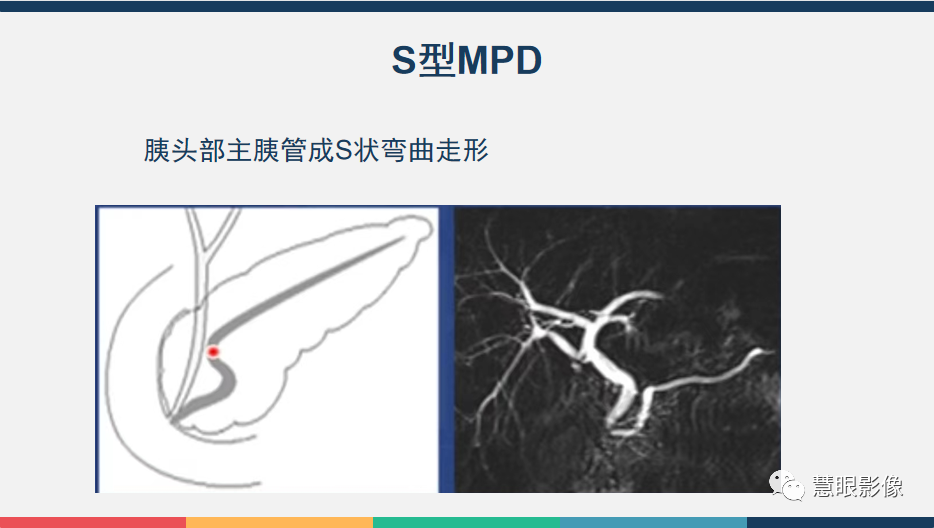 影像PPT - 【PPT】胰腺解剖变异、发育异常及相关病变影像评估-9