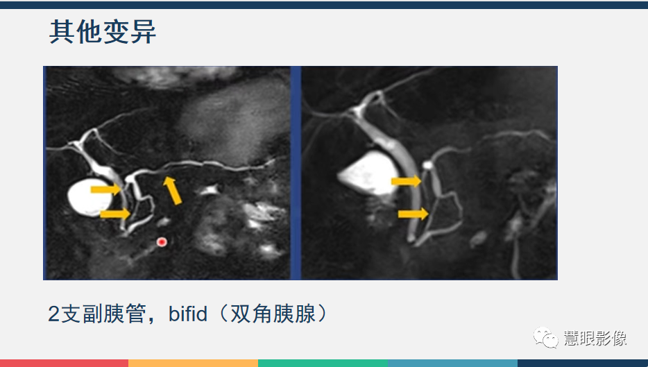 影像PPT - 【PPT】胰腺解剖变异、发育异常及相关病变影像评估-10