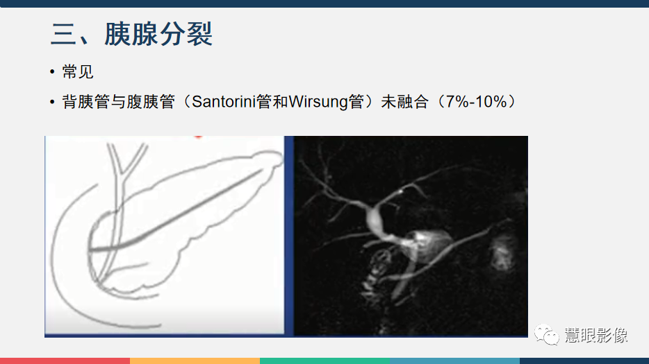 影像PPT - 【PPT】胰腺解剖变异、发育异常及相关病变影像评估-14