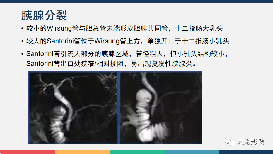 影像PPT - 【PPT】胰腺解剖变异、发育异常及相关病变影像评估-15
