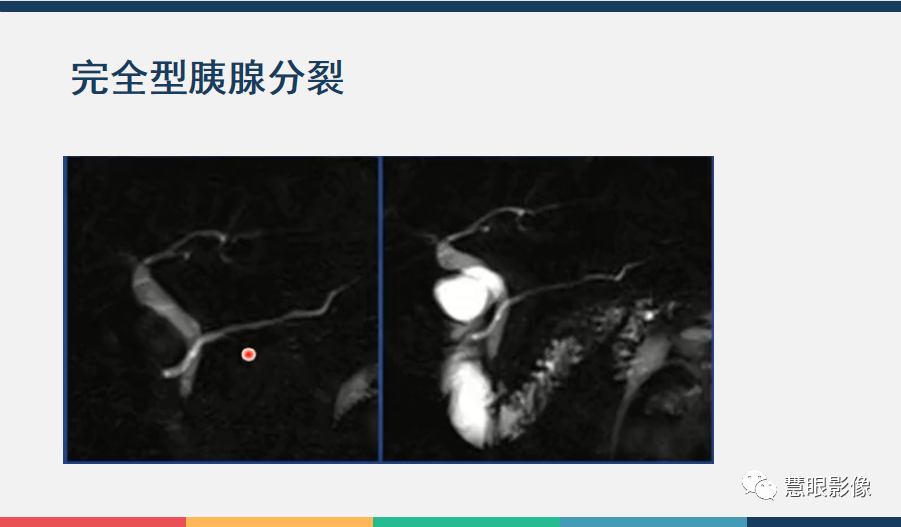 影像PPT - 【PPT】胰腺解剖变异、发育异常及相关病变影像评估-16