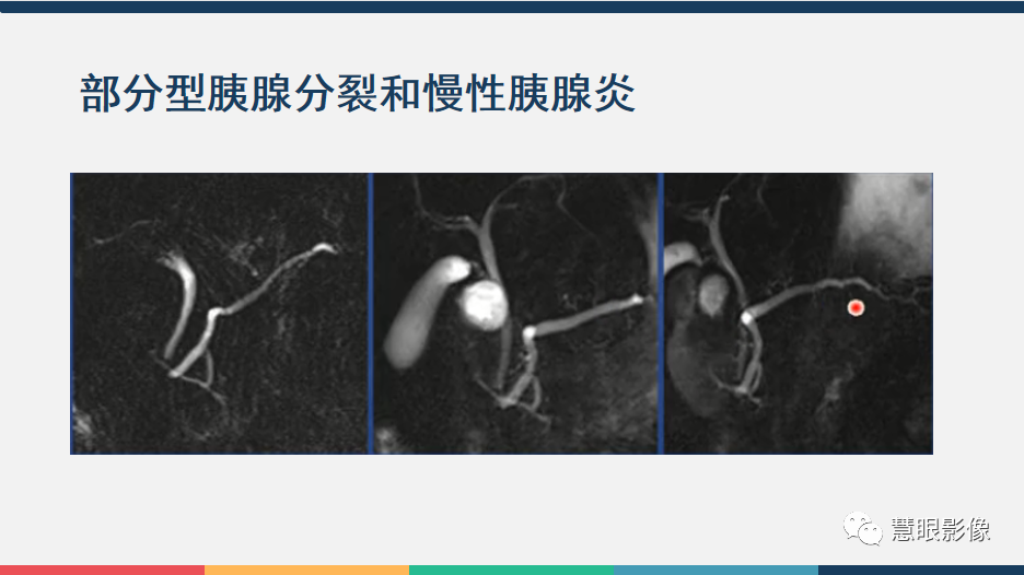 影像PPT - 【PPT】胰腺解剖变异、发育异常及相关病变影像评估-17