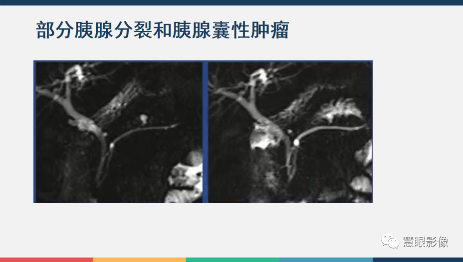 影像PPT - 【PPT】胰腺解剖变异、发育异常及相关病变影像评估-18