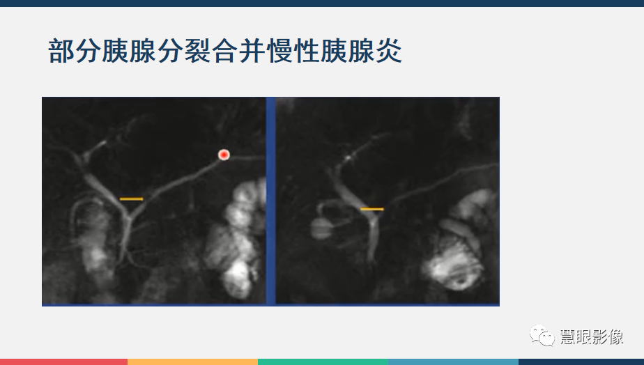 影像PPT - 【PPT】胰腺解剖变异、发育异常及相关病变影像评估-19
