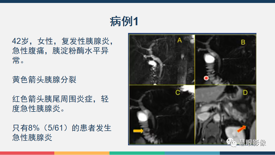 影像PPT - 【PPT】胰腺解剖变异、发育异常及相关病变影像评估-22