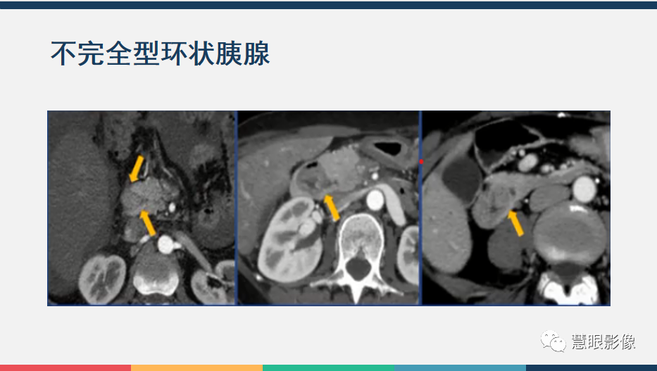 影像PPT - 【PPT】胰腺解剖变异、发育异常及相关病变影像评估-24