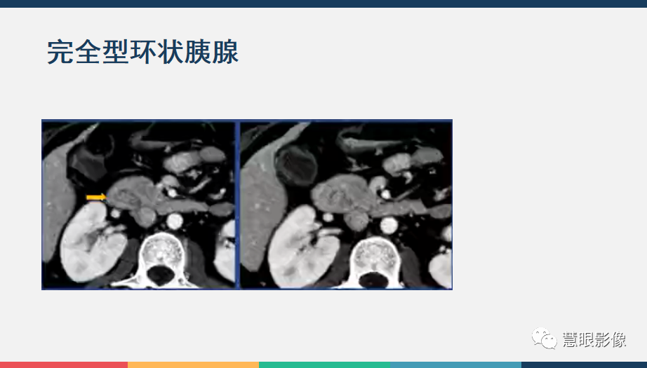 影像PPT - 【PPT】胰腺解剖变异、发育异常及相关病变影像评估-25