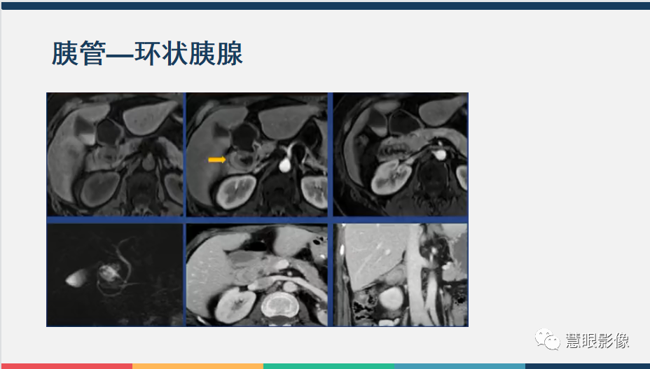 影像PPT - 【PPT】胰腺解剖变异、发育异常及相关病变影像评估-26