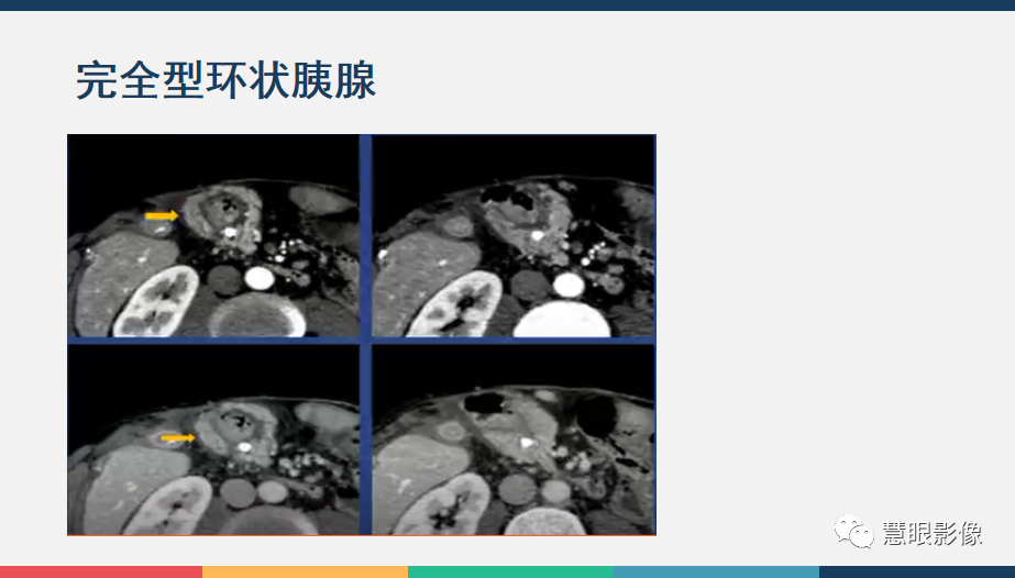 影像PPT - 【PPT】胰腺解剖变异、发育异常及相关病变影像评估-27