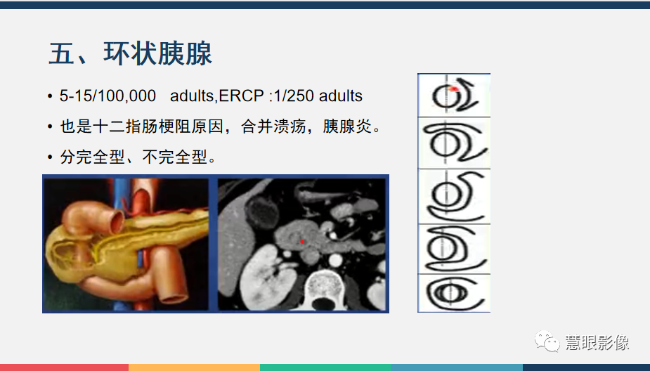 影像PPT - 【PPT】胰腺解剖变异、发育异常及相关病变影像评估-23
