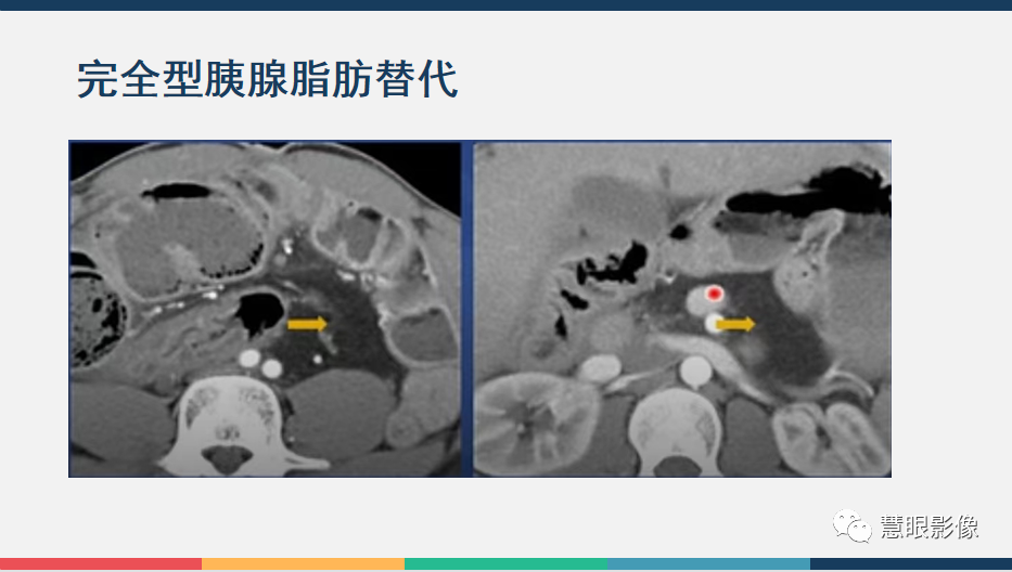影像PPT - 【PPT】胰腺解剖变异、发育异常及相关病变影像评估-29